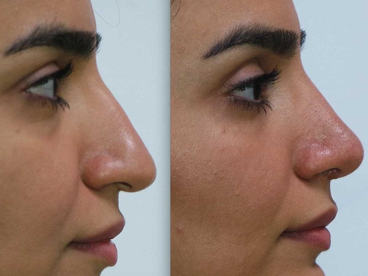 closed rhinoplasty recovery