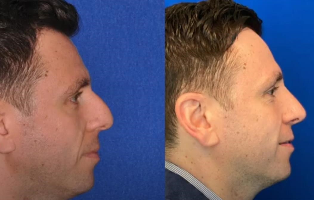 closed rhinoplasty recovery