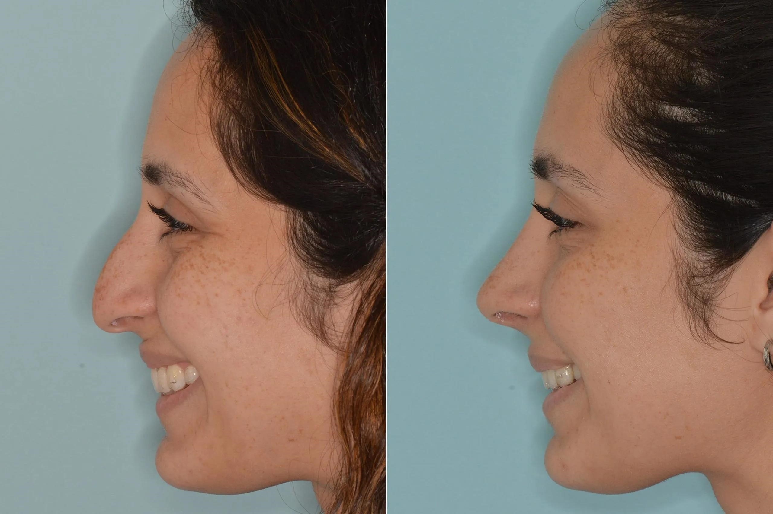 closed rhinoplasty procedure