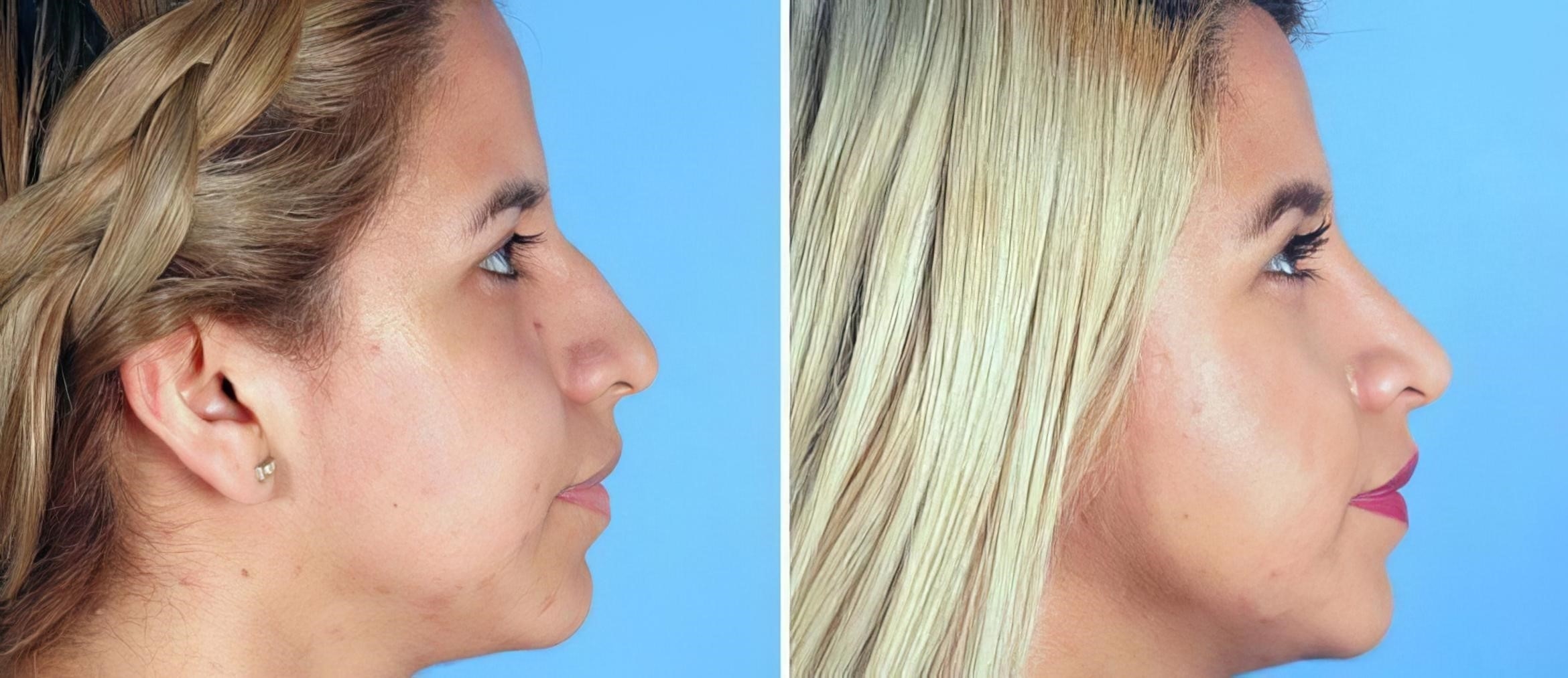 closed rhinoplasty procedure