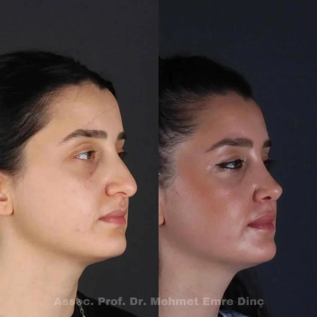 closed rhinoplasty procedure