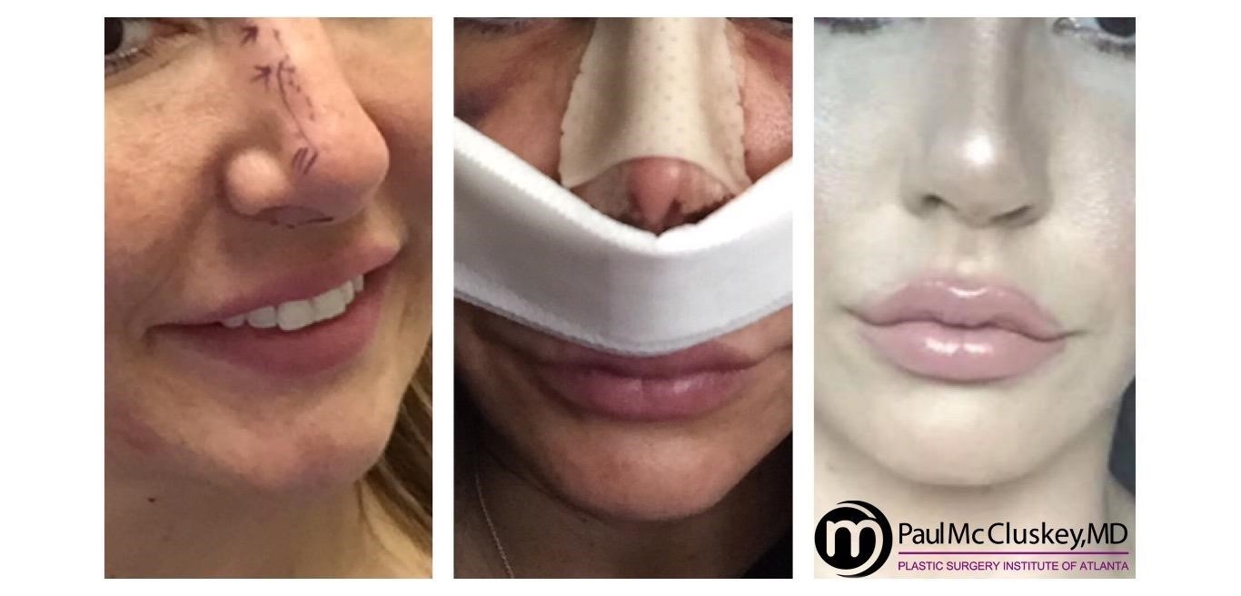 closed rhinoplasty recovery